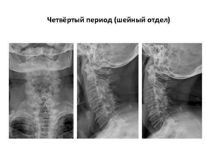 Четвёртый период (шейный отдел) 