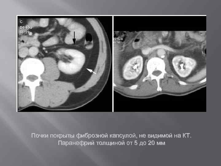 Почки покрыты фиброзной капсулой, не видимой на КТ. Паранефрий толщиной от 5 до 20
