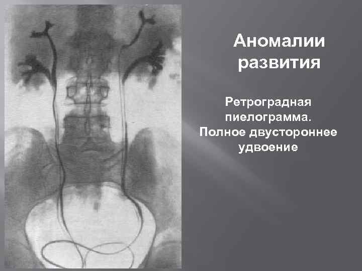 Аномалии развития Ретроградная пиелограмма. Полное двустороннее удвоение 