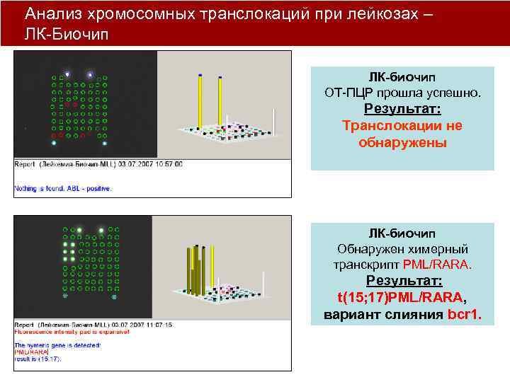 Анализ хромосомных транслокаций при лейкозах – ЛК-Биочип ЛК-биочип ОТ-ПЦР прошла успешно. Результат: Транслокации не