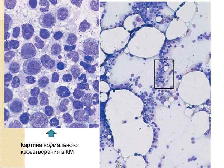 Картина нормального кроветворения в КМ 