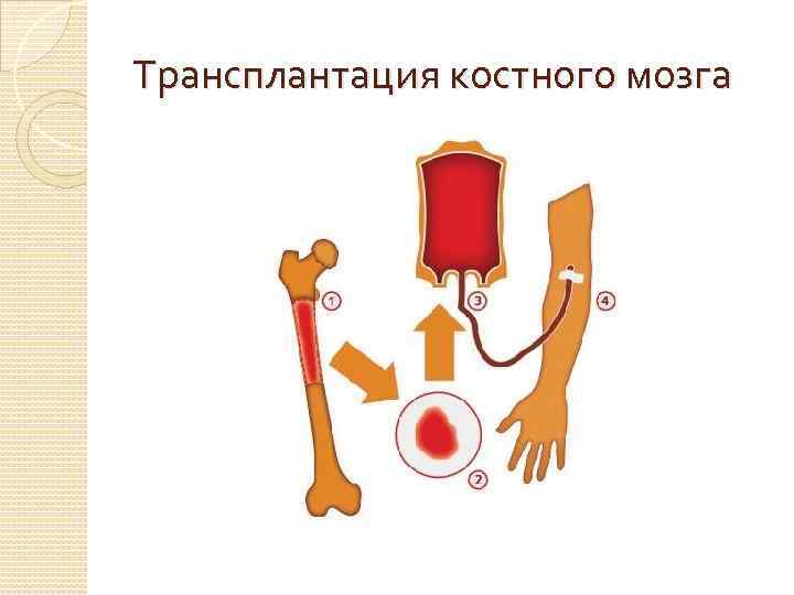 Трансплантация костного мозга 