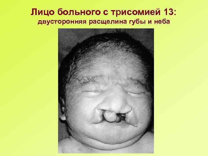 Лицо больного с трисомией 13: двусторонняя расщелина губы и неба 