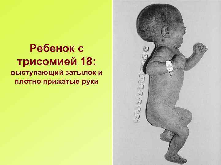 Ребенок с трисомией 18: выступающий затылок и плотно прижатые руки 