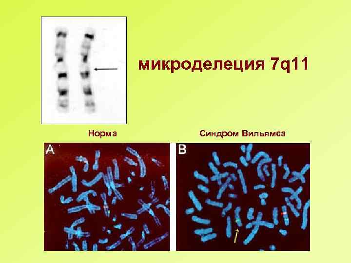 микроделеция 7 q 11 Норма Синдром Вильямса 