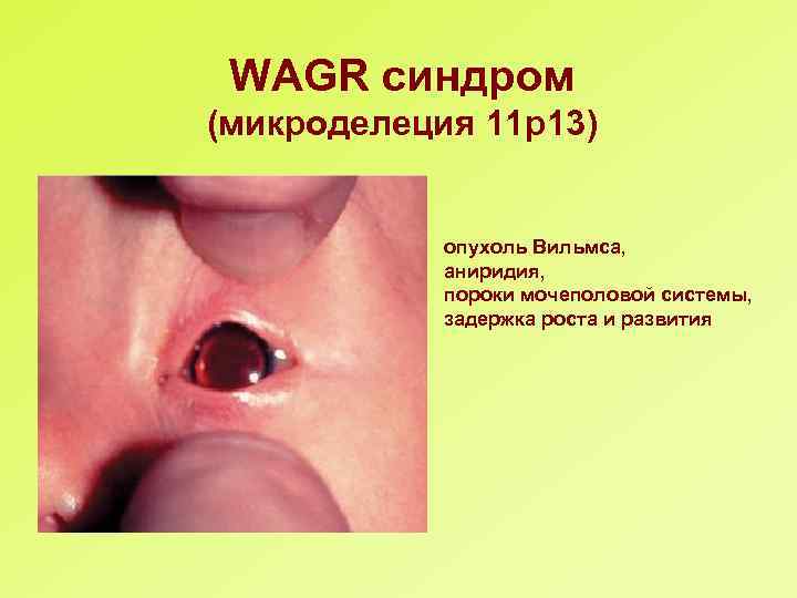 WAGR синдром (микроделеция 11 р13) опухоль Вильмса, аниридия, пороки мочеполовой системы, задержка роста и