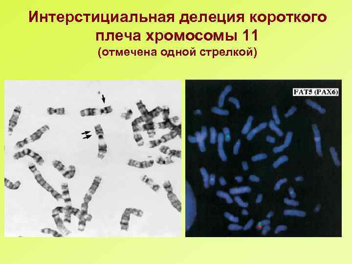 Интерстициальная делеция короткого плеча хромосомы 11 (отмечена одной стрелкой) 