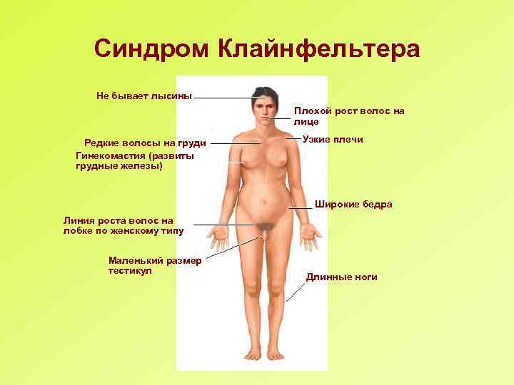 Синдром Клайнфельтера Не бывает лысины Плохой рост волос на лице Редкие волосы на груди