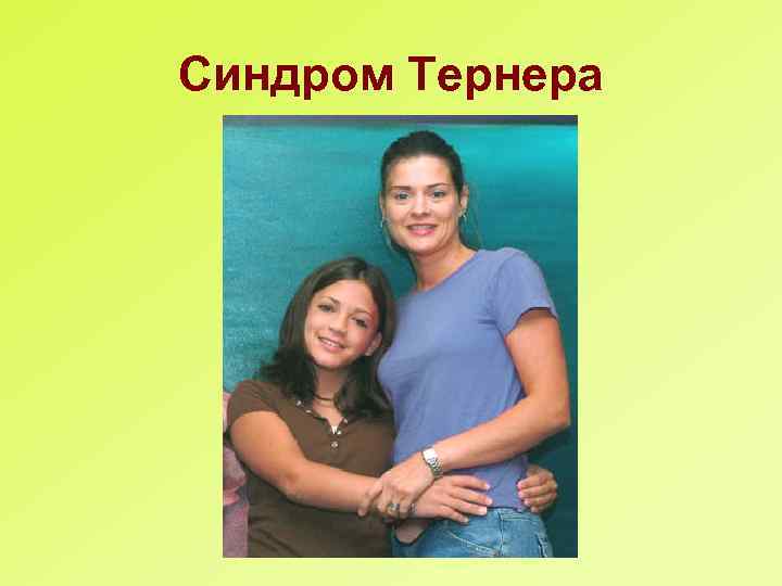 Синдром Тернера 