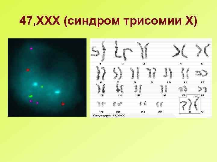 Хромосомные аберрации. Синдром трисомии хромосомы х (47, ххх). Трисомия ххх. Синдромы с хромосомными аберрациями.