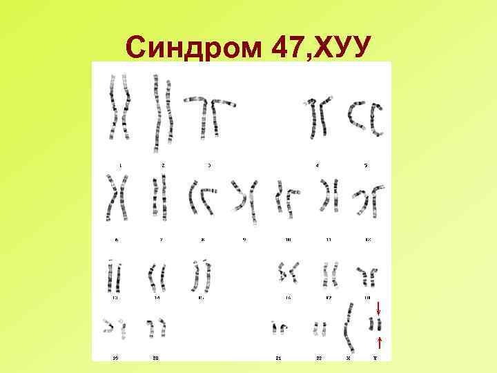 Синдром 47, ХУУ 