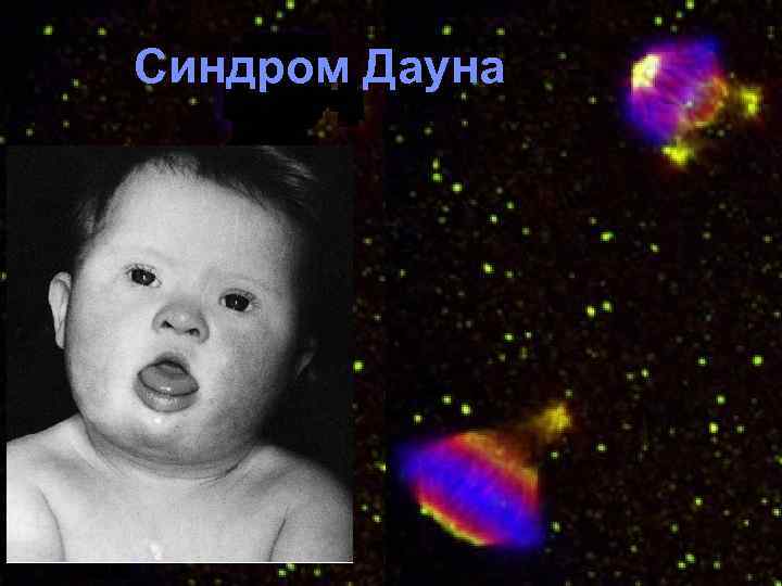 Синдром Дауна 