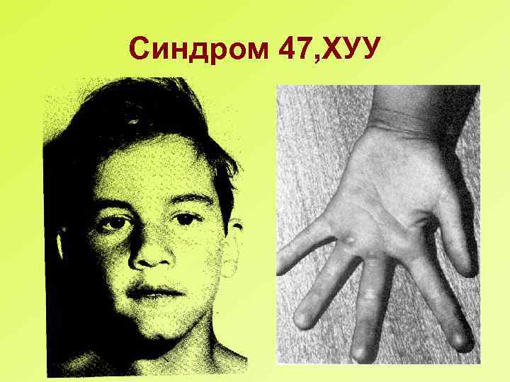 Синдром 47, ХУУ 