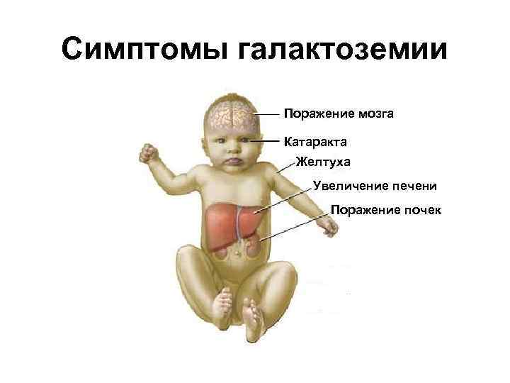 Симптомы галактоземии Поражение мозга Катаракта Желтуха Увеличение печени Поражение почек 