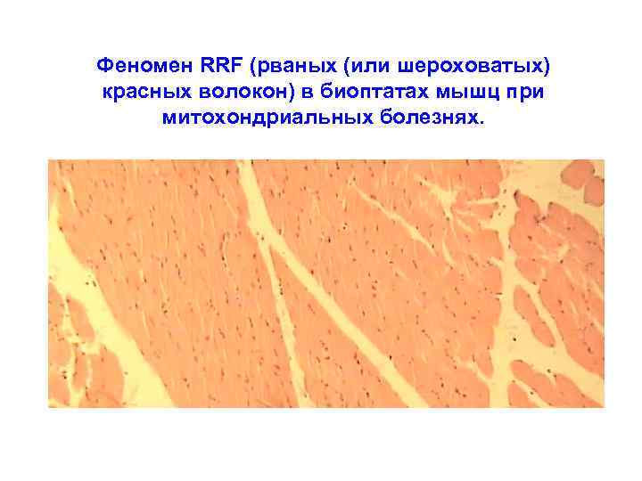 Феномен RRF (рваных (или шероховатых) красных волокон) в биоптатах мышц при митохондриальных болезнях. 