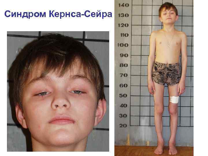 Синдром Кернса-Сейра 