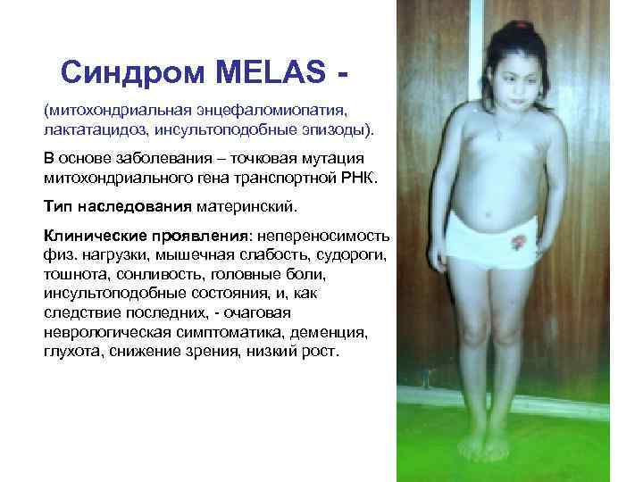 Синдром MELAS (митохондриальная энцефаломиопатия, лактатацидоз, инсультоподобные эпизоды). В основе заболевания – точковая мутация митохондриального