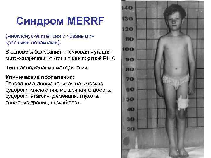 Синдром MERRF (миоклонус-эпилепсия с «рваными» красными волокнами). В основе заболевания – точковая мутация митохондриального