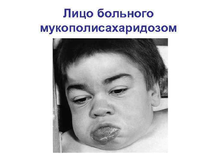 Лицо больного мукополисахаридозом 