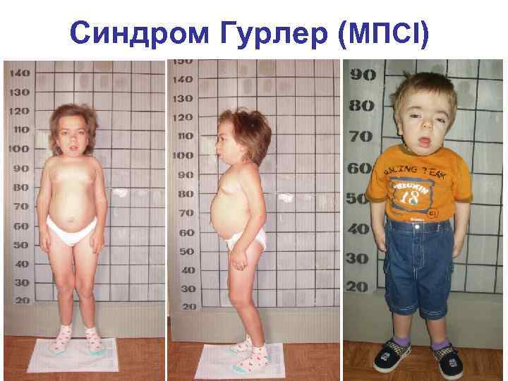 Синдром Гурлер (МПСI) 