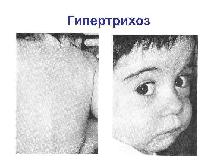 Гипертрихоз 