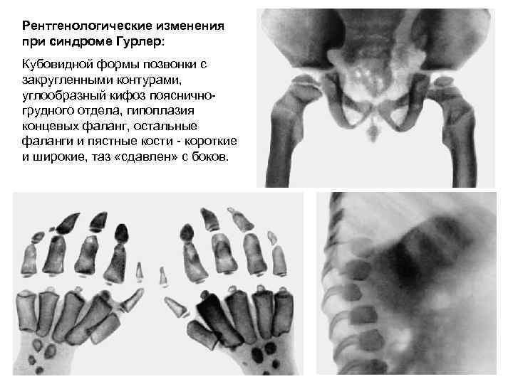 Рентгенологические изменения при синдроме Гурлер: Кубовидной формы позвонки с закругленными контурами, углообразный кифоз поясничногрудного