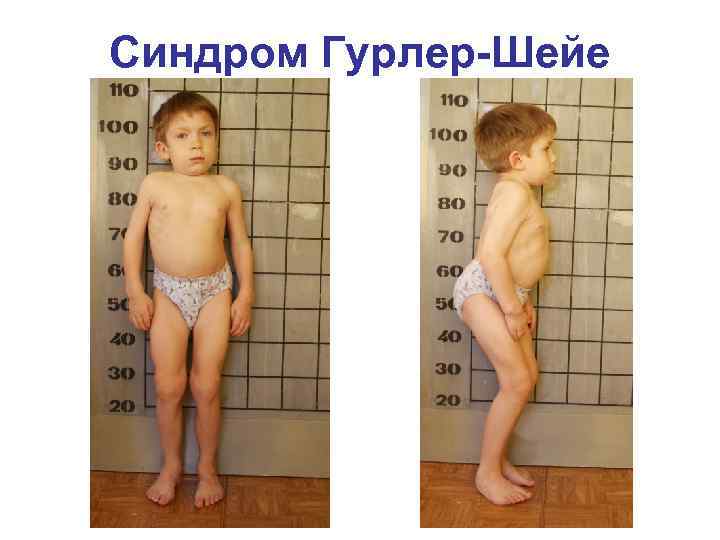 Синдром Гурлер-Шейе 