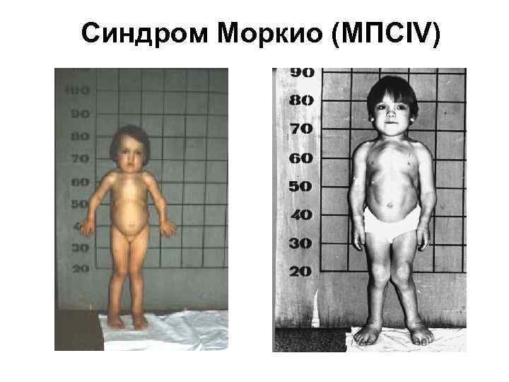 Синдром Моркио (МПСIV) 