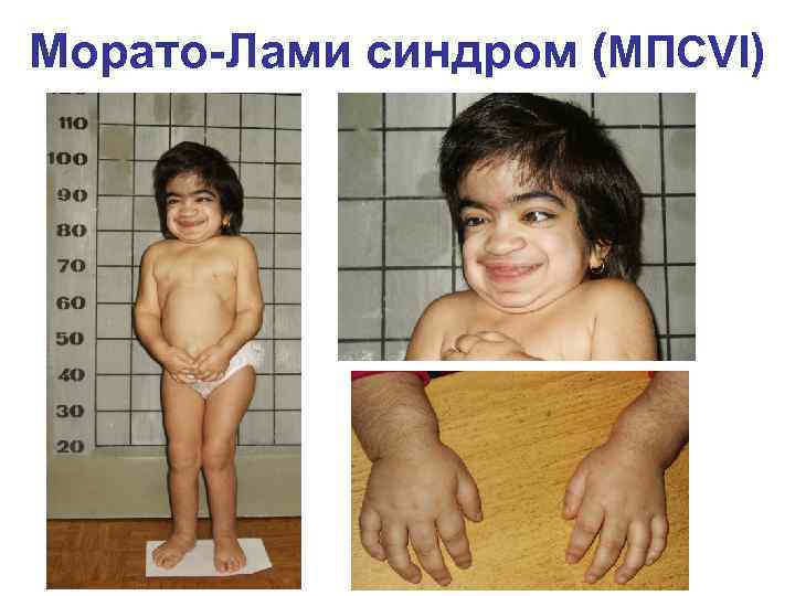 Морато-Лами синдром (МПСVI) 