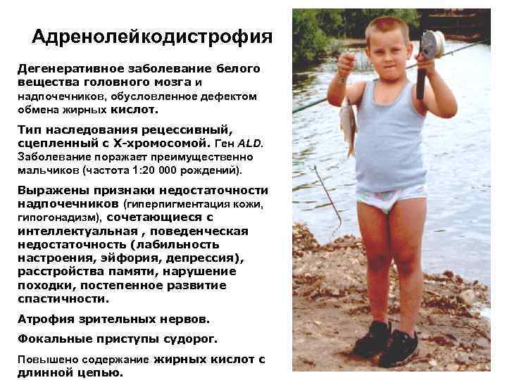 Адренолейкодистрофия Дегенеративное заболевание белого вещества головного мозга и надпочечников, обусловленное дефектом обмена жирных кислот.