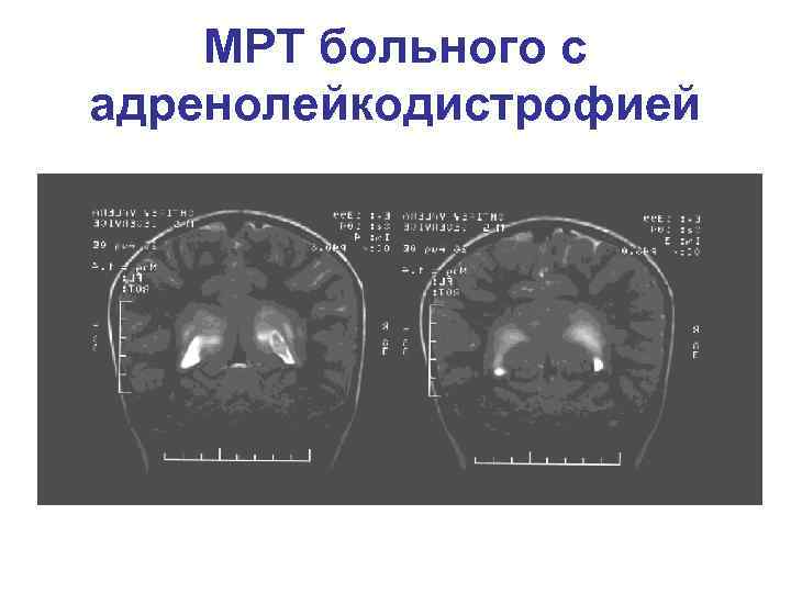 МРТ больного с адренолейкодистрофией 