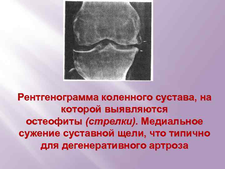 Рентгенограмма коленного сустава, на которой выявляются остеофиты (стрелки). Медиальное сужение суставной щели, что типично