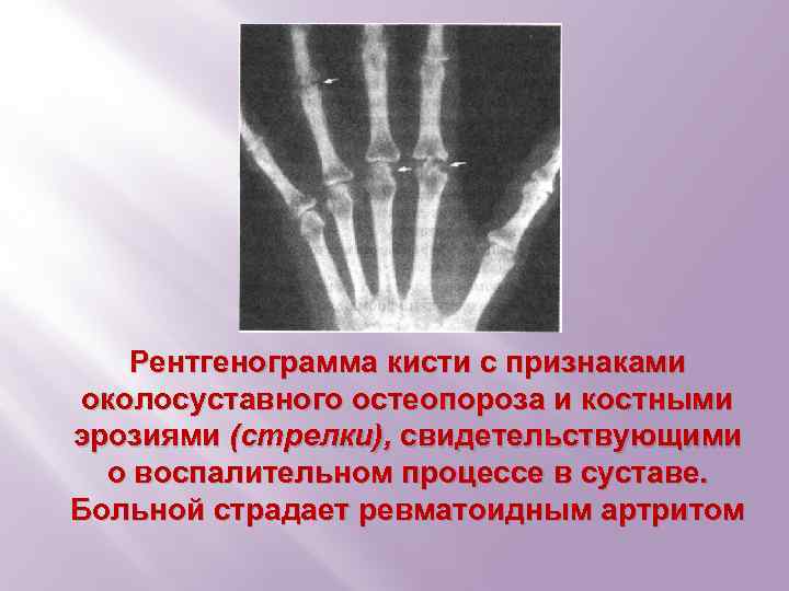 Рентгенограмма кисти с признаками околосуставного остеопороза и костными эрозиями (стрелки), свидетельствующими о воспалительном процессе