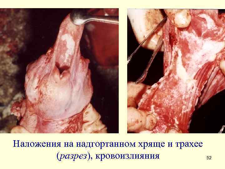 Наложения на надгортанном хряще и трахее (разрез), кровоизлияния 52 