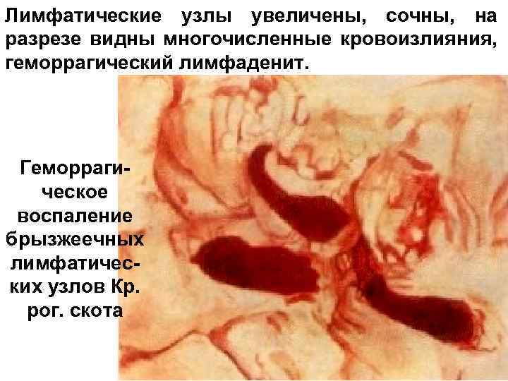 Лимфатические узлы увеличены, сочны, на разрезе видны многочисленные кровоизлияния, геморрагический лимфаденит. Геморрагическое воспаление брызжеечных