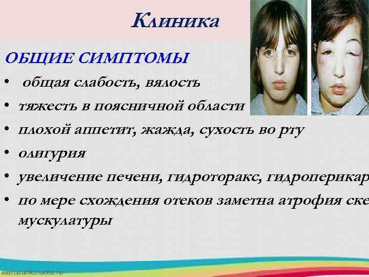 Клиника ОБЩИЕ СИМПТОМЫ • общая слабость, вялость • тяжесть в поясничной области • плохой