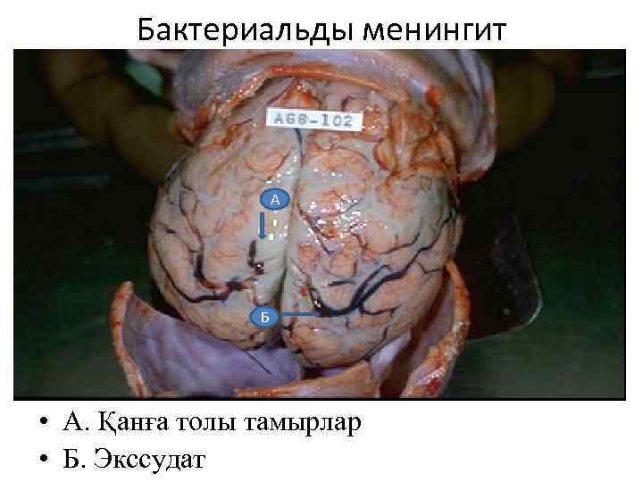 Бактериальды менингит А Б • А. Қанға толы тамырлар • Б. Экссудат 