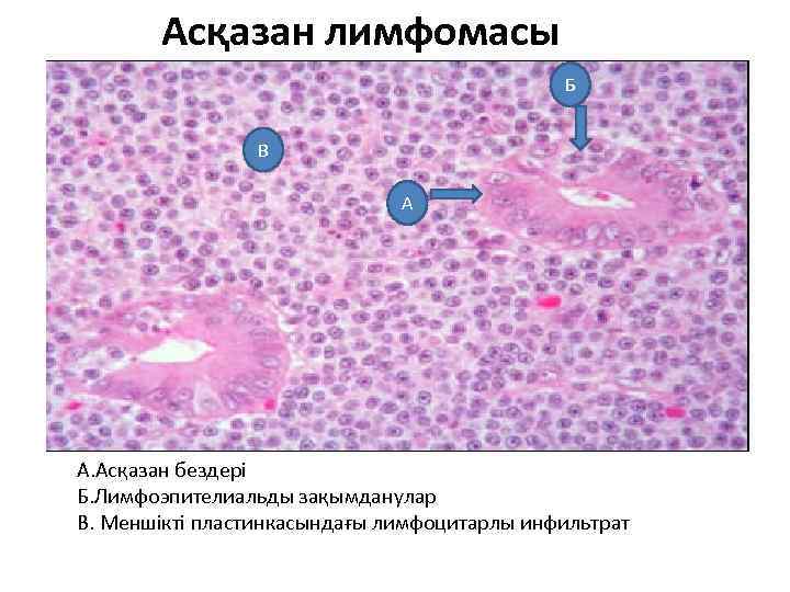  Асқазан лимфомасы Б В А • А. Асқазан бездері Б. Лимфоэпителиальды зақымданулар В.