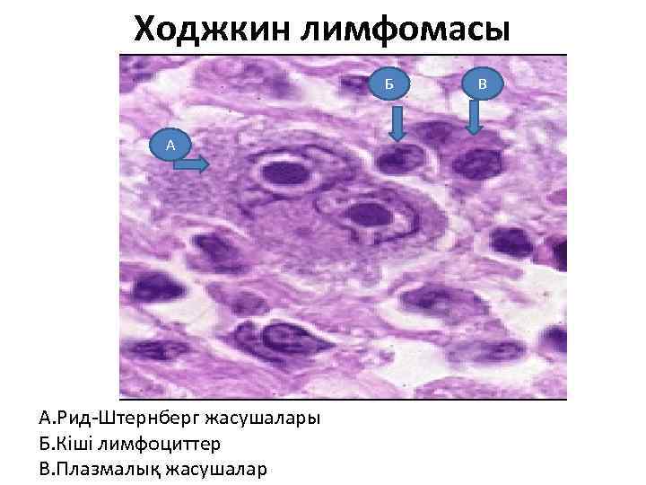 Ходжкин лимфомасы Б А А. Рид-Штернберг жасушалары Б. Кіші лимфоциттер В. Плазмалық жасушалар В