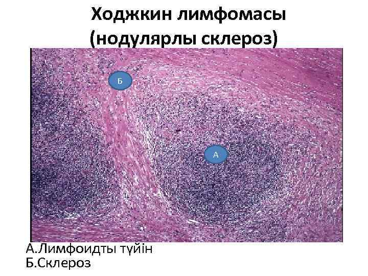  Ходжкин лимфомасы (нодулярлы склероз) Б А А. Лимфоидты түйін Б. Склероз 