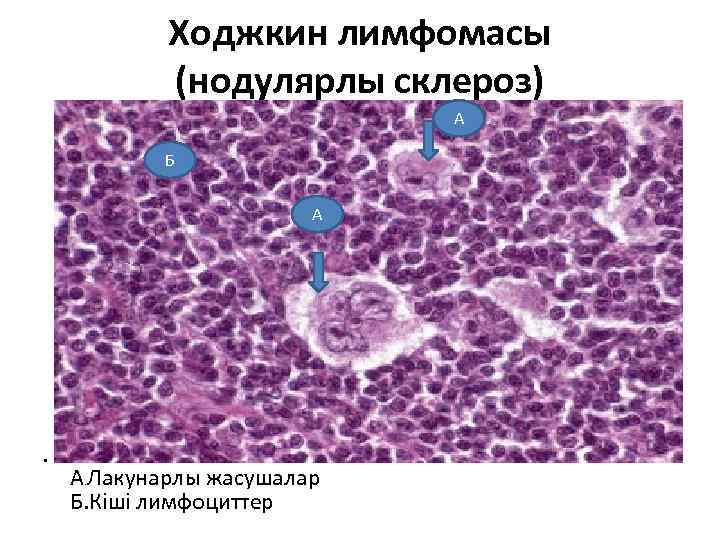 Ходжкин лимфомасы (нодулярлы склероз) А Б А • А. Лакунарлы жасушалар Б. Кіші лимфоциттер