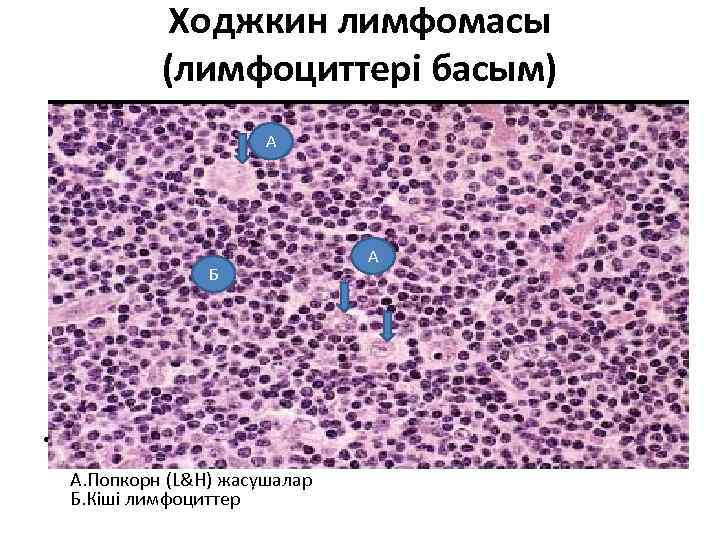 Ходжкин лимфомасы (лимфоциттері басым) А Б • А. Попкорн (L&H) жасушалар Б. Кіші лимфоциттер