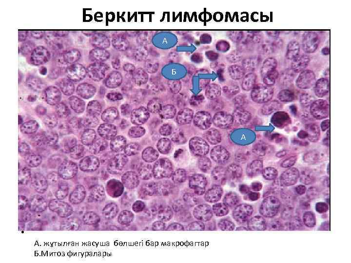  Беркитт лимфомасы А Б А • А. жұтылған жасуша бөлшегі бар макрофагтар Б.