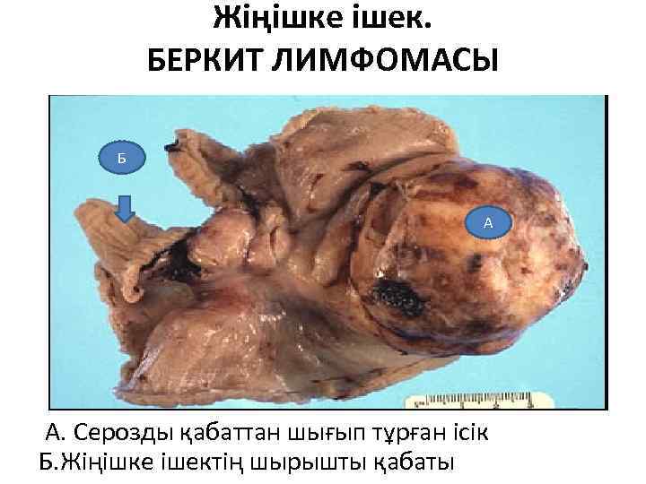 Жіңішке ішек. БЕРКИТ ЛИМФОМАСЫ Б А А. Серозды қабаттан шығып тұрған ісік Б. Жіңішке