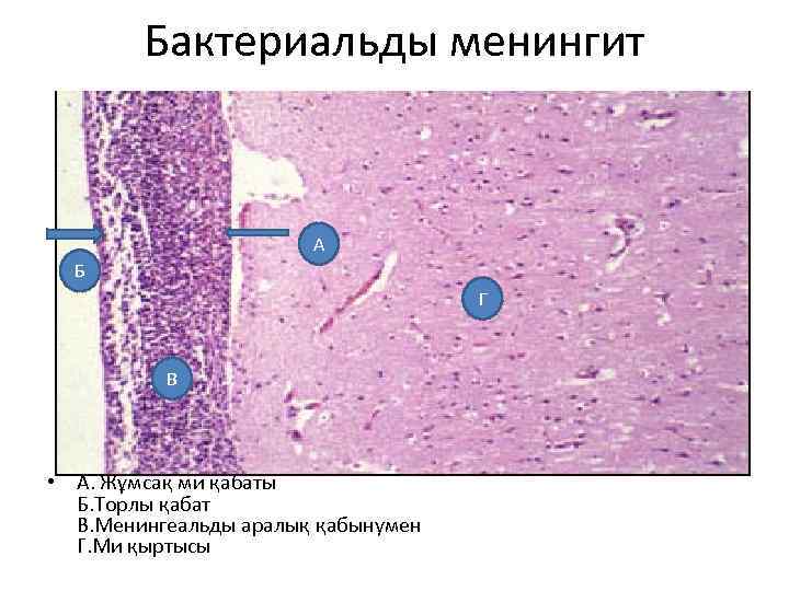 Бактериальды менингит А Б Г В • А. Жұмсақ ми қабаты Б. Торлы қабат