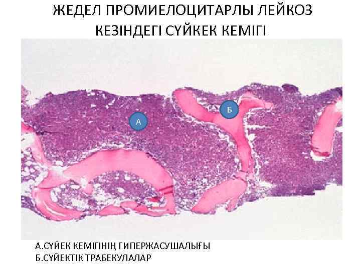  ЖЕДЕЛ ПРОМИЕЛОЦИТАРЛЫ ЛЕЙКОЗ КЕЗІНДЕГІ СҮЙКЕК КЕМІГІ Б А • А. СҮЙЕК КЕМІГІНІҢ ГИПЕРЖАСУШАЛЫҒЫ