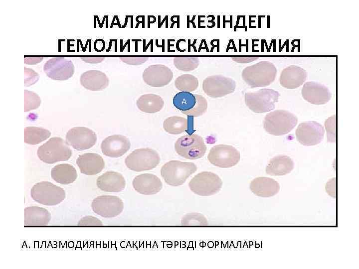  МАЛЯРИЯ КЕЗІНДЕГІ ГЕМОЛИТИЧЕСКАЯ АНЕМИЯ А А. ПЛАЗМОДИЯНЫҢ САҚИНА ТӘРІЗДІ ФОРМАЛАРЫ 