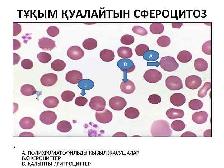 ТҰҚЫМ ҚУАЛАЙТЫН СФЕРОЦИТОЗ А В Б • А. ПОЛИХРОМАТОФИЛЬДЫ ҚЫЗЫЛ ЖАСУШАЛАР Б. СФЕРОЦИТТЕР В.