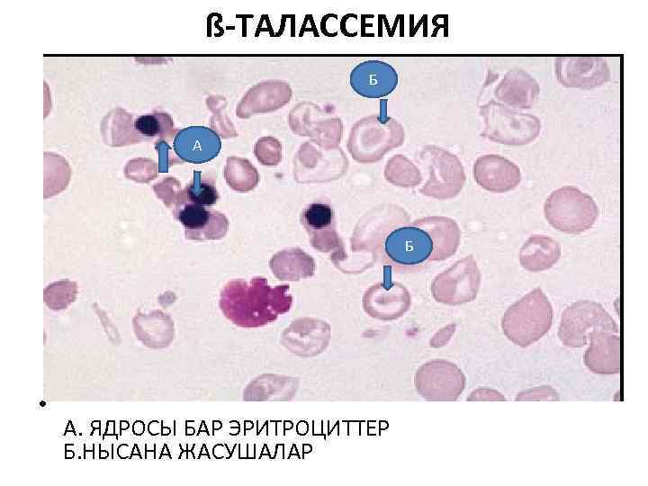  ß-ТАЛАССЕМИЯ Б А Б • А. ЯДРОСЫ БАР ЭРИТРОЦИТТЕР Б. НЫСАНА ЖАСУШАЛАР 