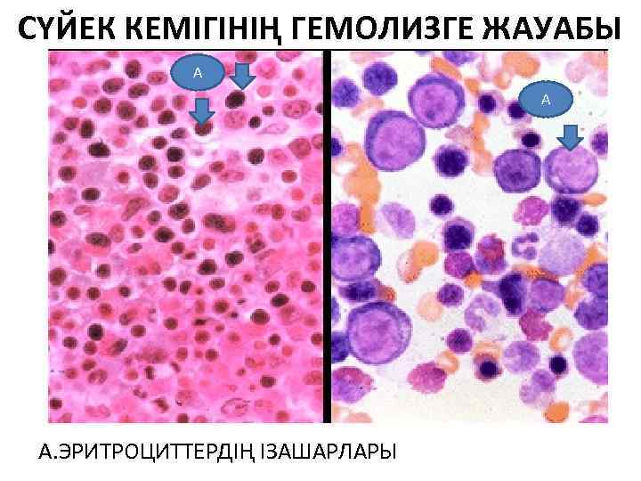 СҮЙЕК КЕМІГІНІҢ ГЕМОЛИЗГЕ ЖАУАБЫ А А А. ЭРИТРОЦИТТЕРДІҢ ІЗАШАРЛАРЫ 
